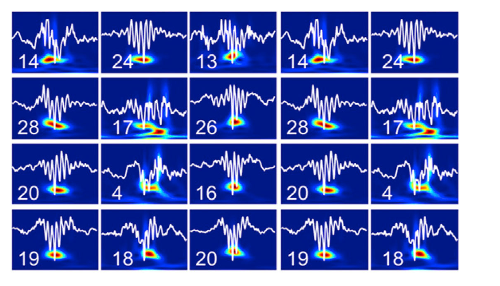 Mechanisms of epileptic fast ripples